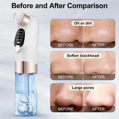 Blackhead Suction Remover Vacuum Pore Cleaner
